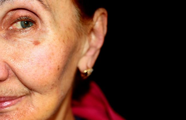 mujer-mancha-mejilla